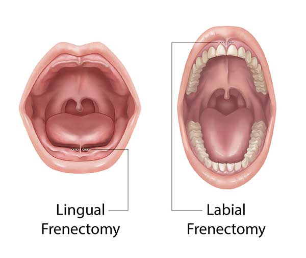 Types of Frenectomy graphic