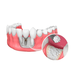 bone graft for tooth implant