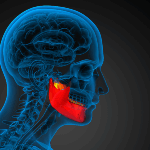 Jaw Surgery
